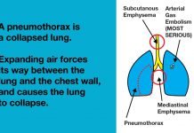 Lung Over Expansion Injuries
